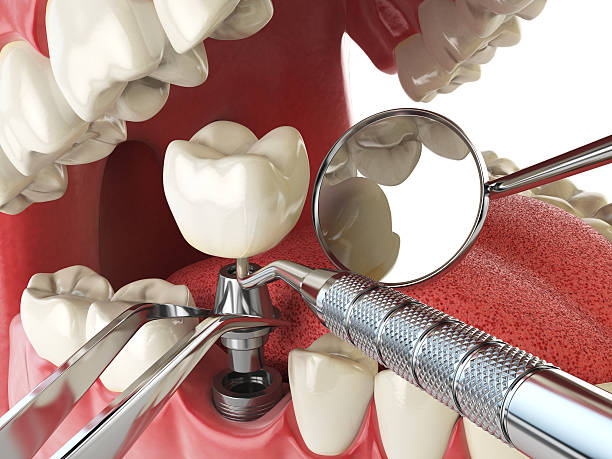 Best Root Canal Emergency Dentist  in Bolindale, OH